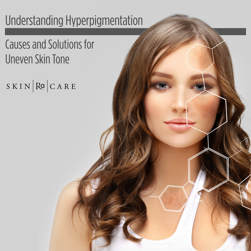 Understanding Hyperpigmentation: Causes and Solutions for Uneven Skin Tone