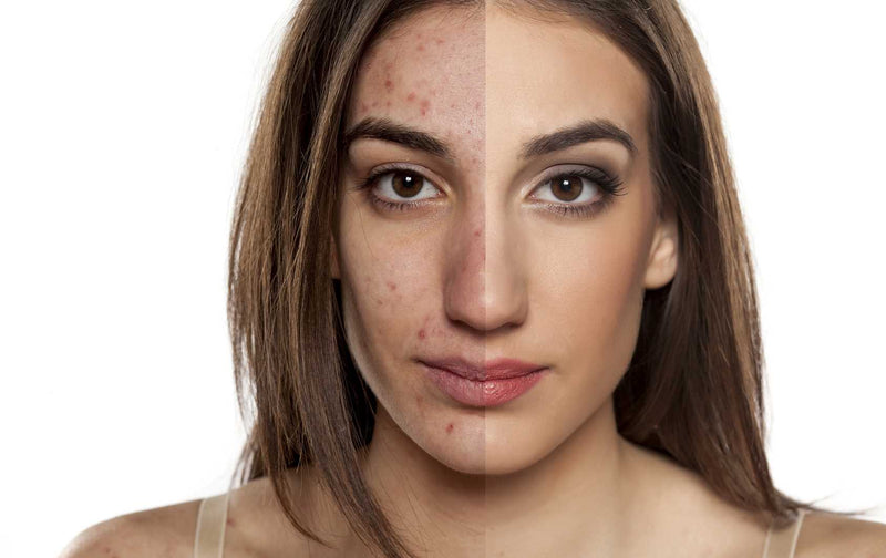 Targeting Different Types of Acne Takes the Right Stuff